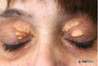 biaya operasi xanthelasma